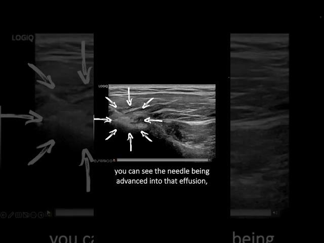 #ultrasound Guided Interventions: Cases (Long Head of Biceps Injection)