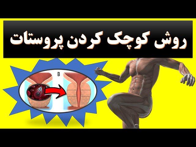 Prostate روش های کوچک کردن پروستات و درمان درد التهاب و شب ادراری