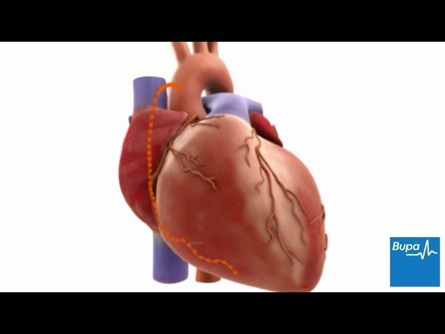 How coronary artery bypass graft (CABG) surgery is carried out | Bupa Health