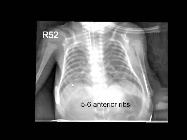 Neonatal Radiography part 1: Nomal Findings and the Basics