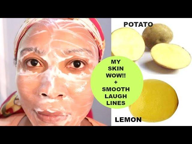 I USE POTATO AND LEMON ON MY SKIN, LOOK WHAT IT DID TO MY SKIN!! CLEAR DARK SPOTS + REMOVE WRINKLES