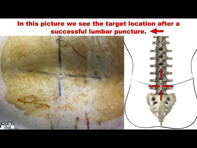 POCUS: Ultrasound Guided Lumbar Puncture