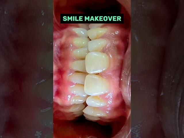 Smile makeover   #smile #shorts #trending #youtube @drneetuagarwal
