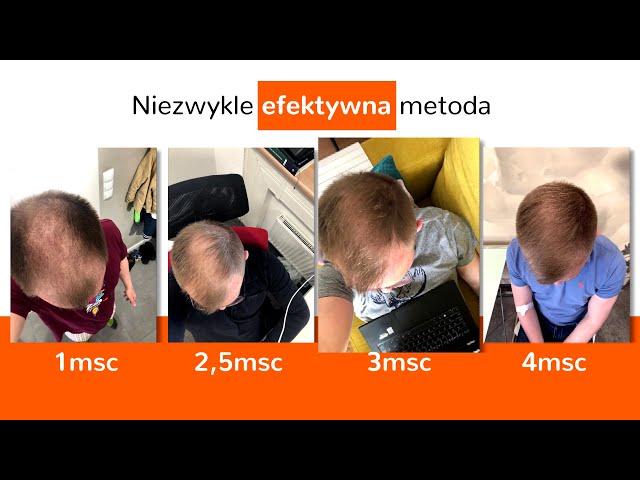 Medestetic Zielona Góra - Przeszczep włosów - metoda FUE