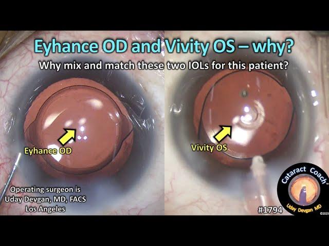 CataractCoach™1794: Eyhance Right Eye and Vivity Left Eye - Why?