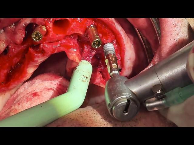 Teeth Tomorrow maxillary surgery