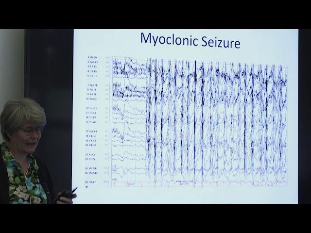 SLC13A5 Clinical Spectrum with Dr. Brenda Porter - SLC13A5 Research Roundtable 2018