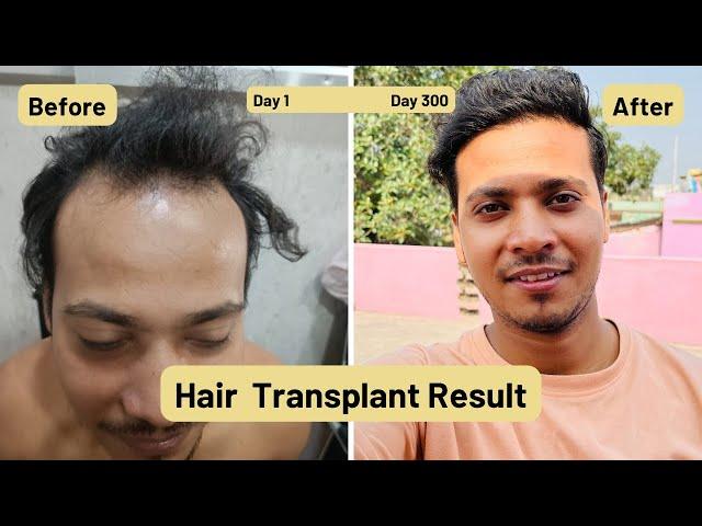 Day 1 to Day 300 Hair Transplant result / Hair Transplant in Jharkhand / 22k views