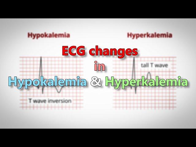 Hypokalemia and Hyperkalemia ECG changes