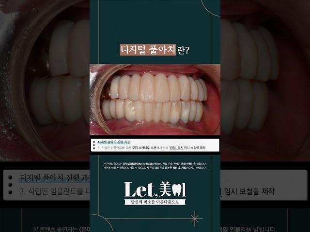 디지털 풀아치란?#임플란트#디지털풀아치#틀니임플란트