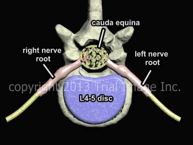 Bulging Disc - What Is It? - Animation and Narration by Cal Shipley, M.D.