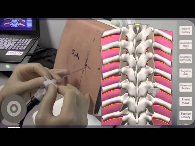 Needle Angulation for Thoracic Paravertebral Block (TPVB)