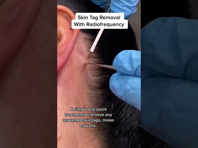 Skin Tag Removal With Radiofrequency | Quick & Safe Treatment DRMEDISPA