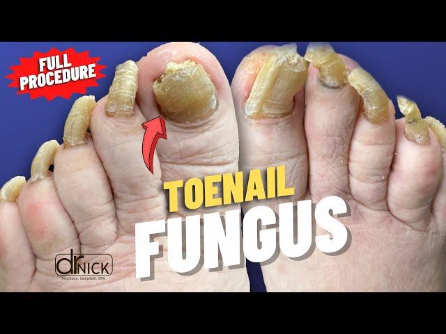 Cutting Extremely Thick Fungal Toenails | Dr. Nick Campitelli