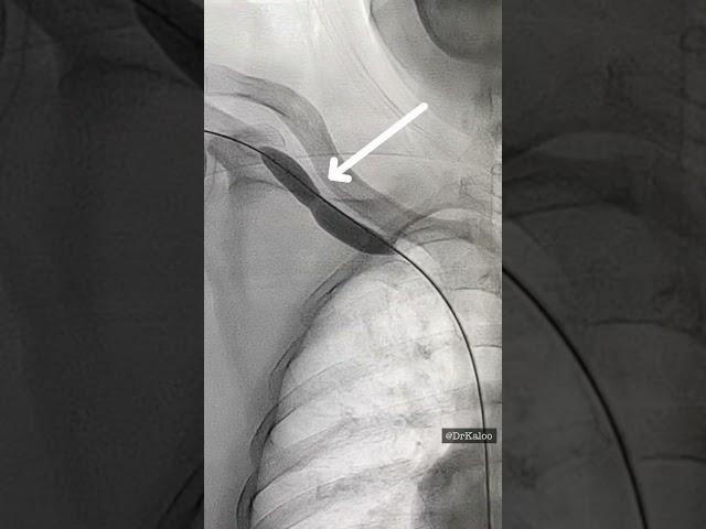 Cephalic vein Stenosis. Balloon Angioplasty of stenosis. Interventional Radiology. #iRad #dialysis