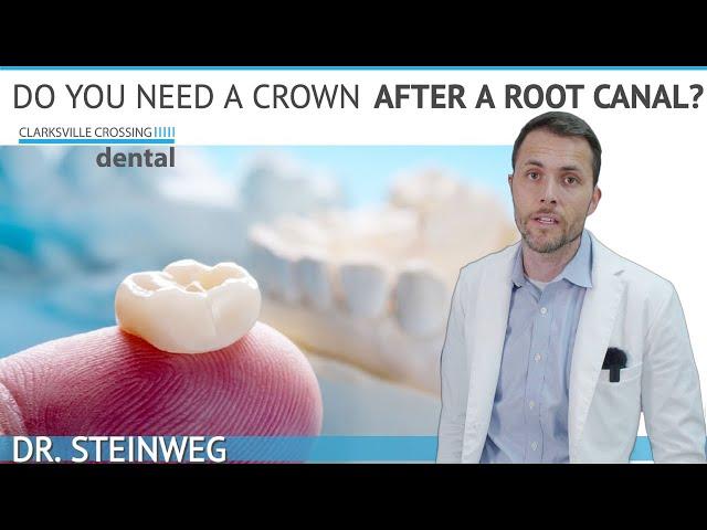 Do I Need Dental Crown After A Root Canal? 