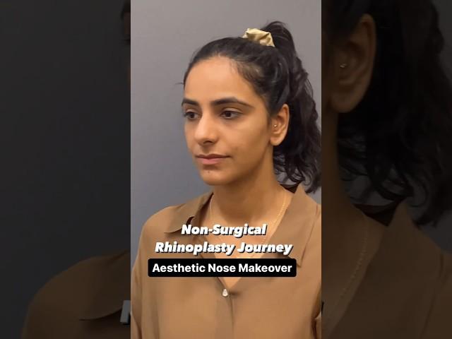 Non Surgical Rhinoplasty Journey | Before & After Nose Transformation | Cara Clinic Mumbai