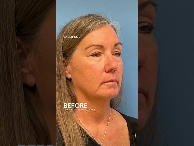 CO Laser Skin Resurfacing Before and After #co2lasertreatment #skinresurfacing #antiageingskincare