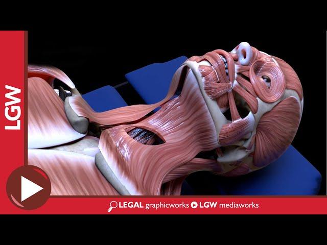 Anterior Cervical Discectomy and Fusion 3D Animation