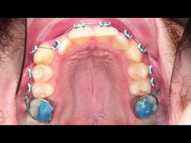 The Art of Braces- Smile Transformation