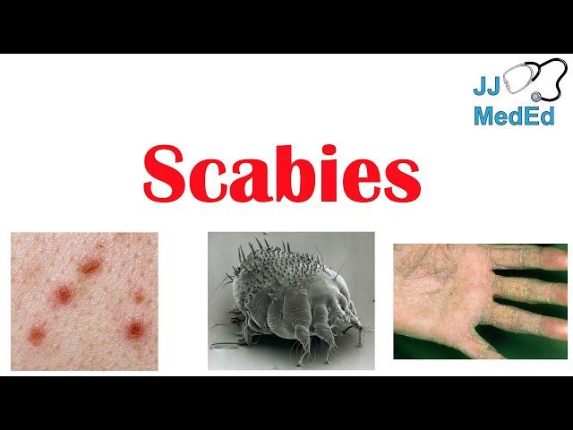 Scabies (Skin Condition) | What Is It, Classic vs. Crusted Types, Signs & Symptoms, Treatment