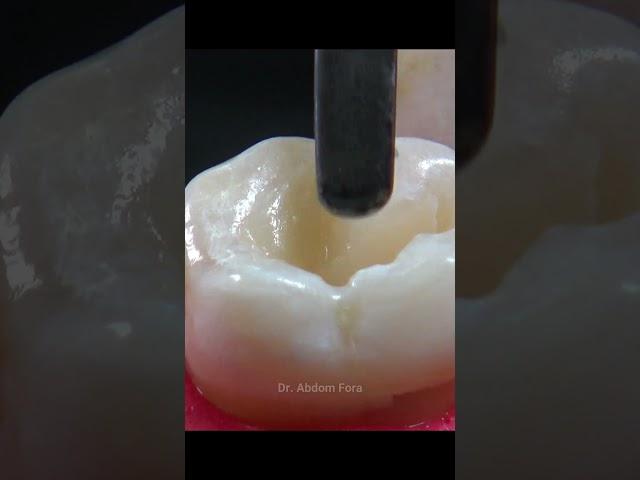 Cavity teeth treatment #asmr