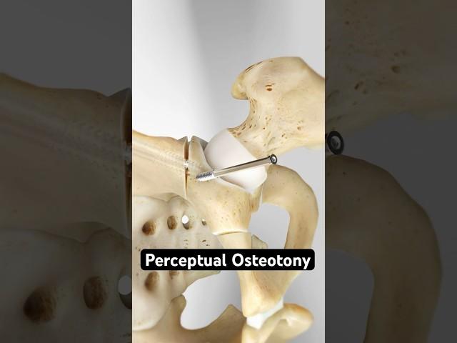 Securing a shallow hip socket (3D Animation)