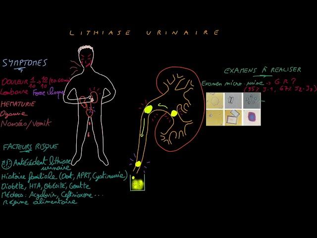 Lithiase urinaire - Docteur Synapse