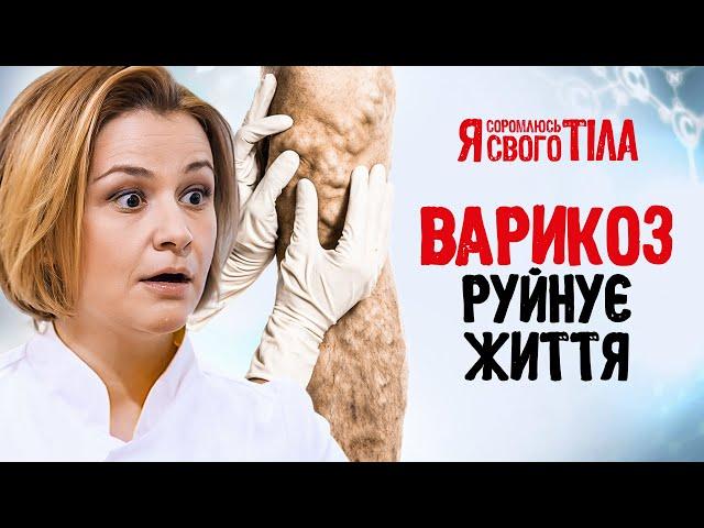 Варикоз не дає відчути себе жінкою – Я соромлюсь свого тіла | ЗДОРОВ’Я | ЛІКУВАННЯ | МЕДИЦИНА