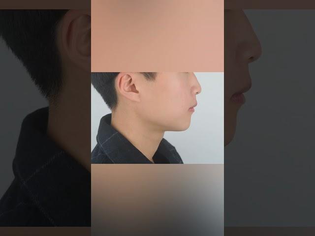 #치아교정. 바람직한 얼굴변화를 일으키는 돌출입교정 (02 886 2877 신도림역 가이교정치과) #치아교정 #돌출입교정 #덧니교정 #돌출입교정비용 #치아교정과정 #부천교정치과
