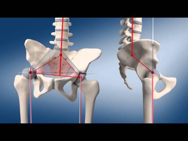 Custom made total hip replacement | Medical Animation