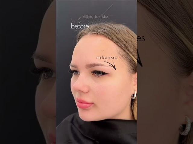 Lip Augmentation Surgery - Procedure, Before & After Results