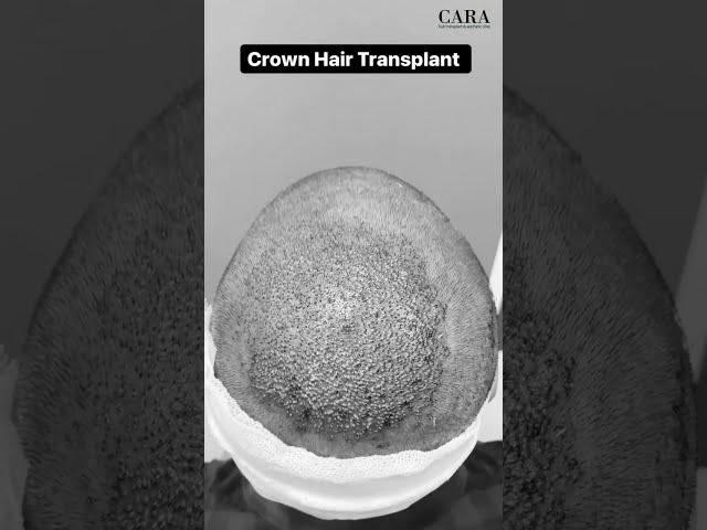 FUE Crown Hair transplant in Mumbai | 1970 hair grafts implantation| best hair transplant #shorts