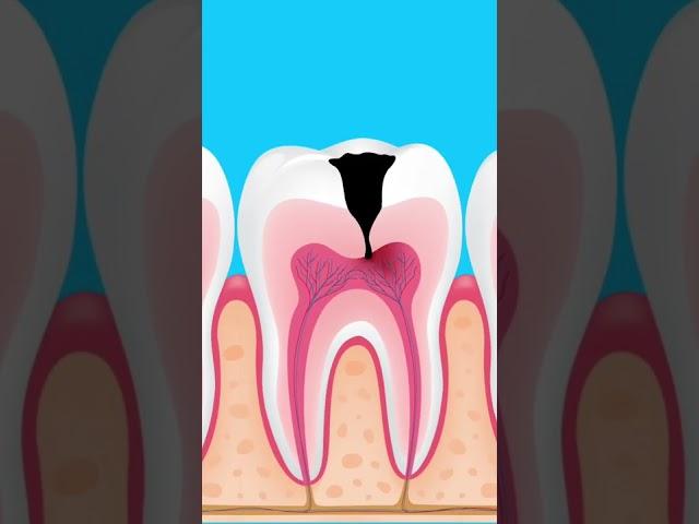 What happens if tooth decay is left untreated