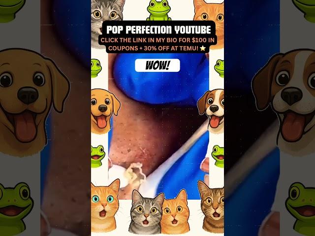 Wow! #youtubeshorts #youtube #shortsfeed #shortvideo #shorts #short #pimple #pimplepopping #pimples