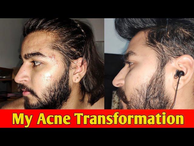 My Acne Transformation Before And After | Sahil Nagpal