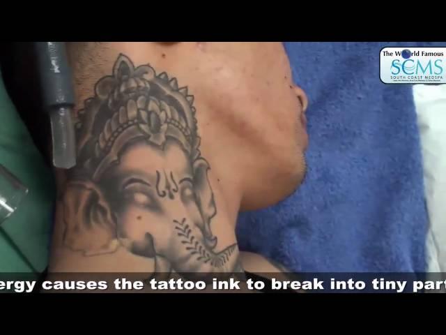 LASER TATTOO REMOVAL COST