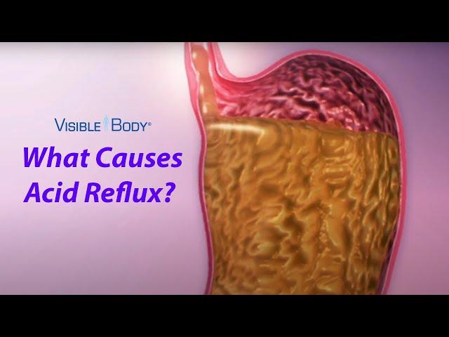 Visible Body | What Causes Acid Reflux?