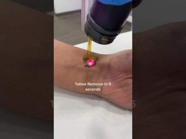 How satisfying is this! #tattooremoval #lasertattooremoval #tattoo #tattooremover #laserclinic