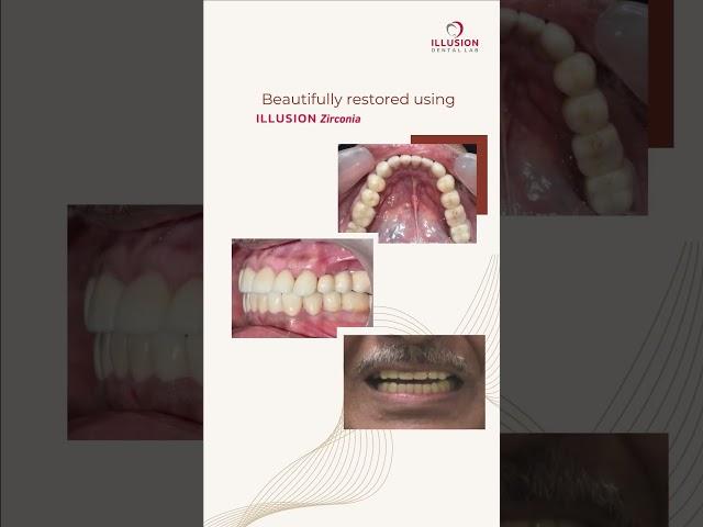 Dr. Varun Mehra restored a missing premolar using an Illusion Zirconia Dental Crown