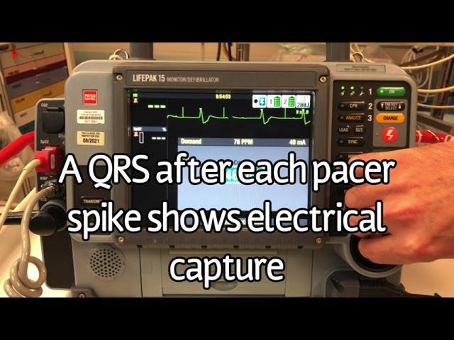 LifePak 15- Transcutaneous Pacing