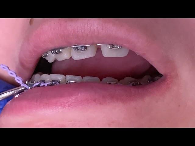 Braces checkups - Power chains & Bite plate off - Tooth Time Family Dentistry