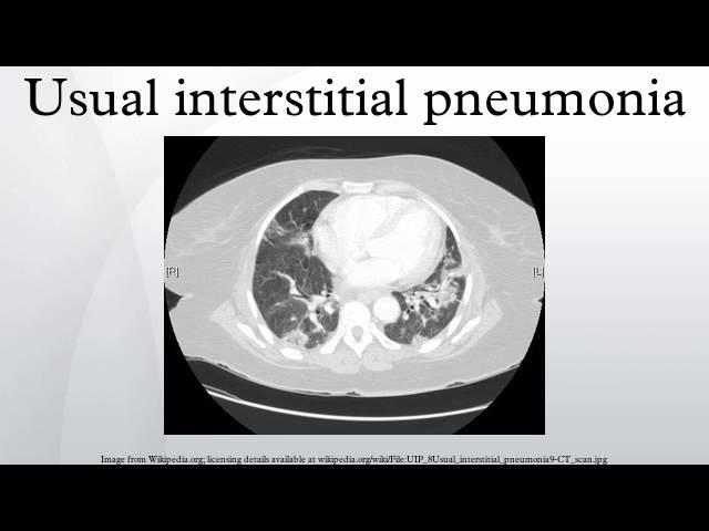 Usual interstitial pneumonia