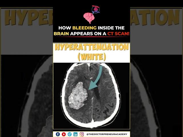  How Brain Bleeding Appears on a CT Scan | Intracerebral Hemorrhage Explained 🩸