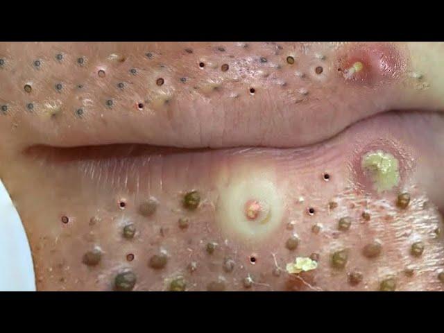 Big Cystic Acne Blackheads Extraction Blackheads & Milia, Whiteheads Removal Pimple Popping # 703