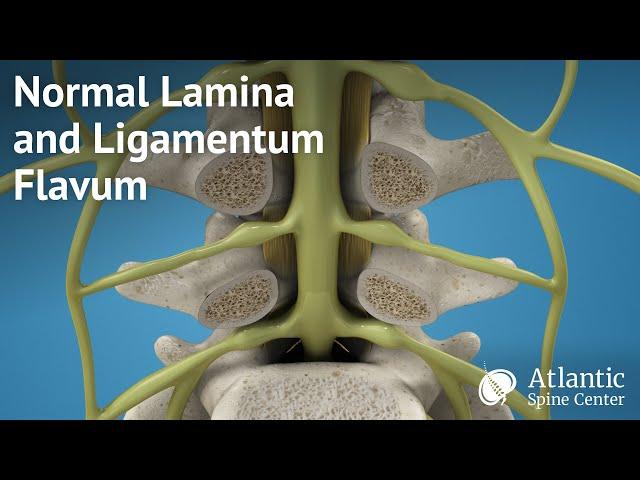 Normal Lamina and Ligamentum Flavum