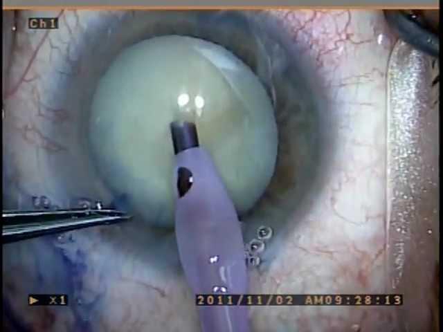"Great White" Cataract Surgery