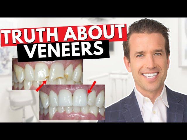 Before you get Dental Veneers Watch This! | Are Veneers Worth It?