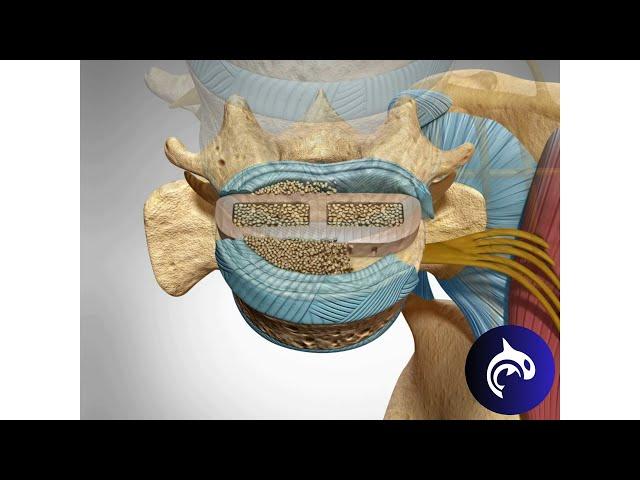 Quick View - Lateral Lumbar Interbody Fusion (LLIF) - 3D Animation.