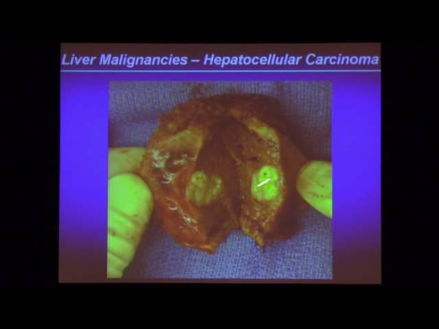 Update on Liver Cancer - Vatche G. Agopian, MD | UCLA Primary Care Update 2015